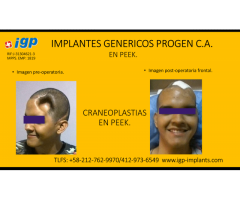 Craneoplastia personalizada, PEEK, en titanio y malla, - Imagen 5/6