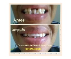 Prótesis dentales en Barquisimeto a excelentes precios