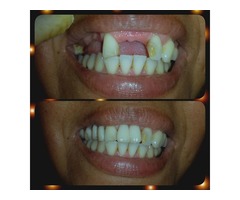 Prótesis dentales en Barquisimeto a excelentes precios - Imagen 3/3